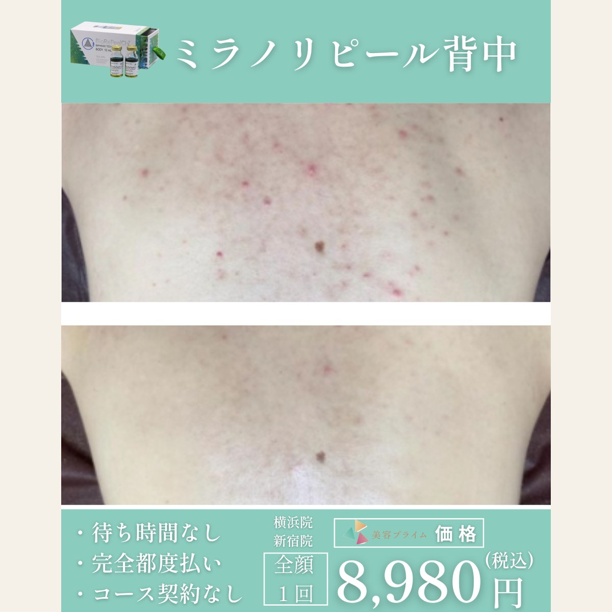 ミラノリピール（背中）