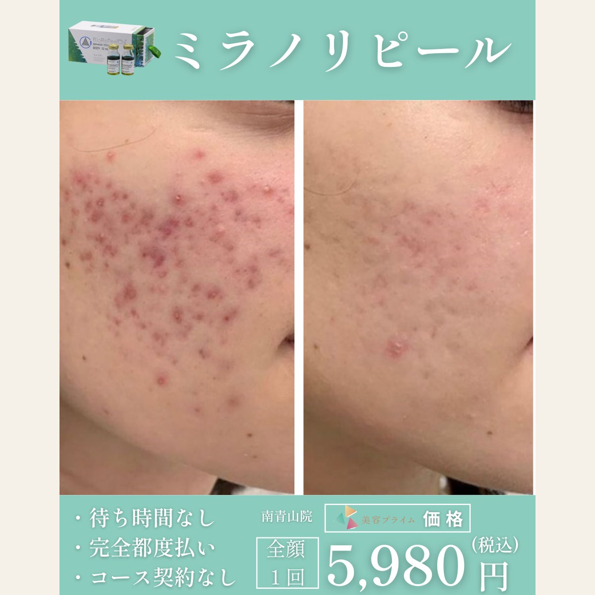 ミラノリピール（顔）