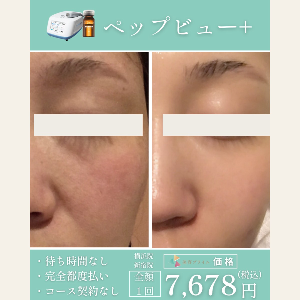 ペップビュー＋（エレクトロポレーション）