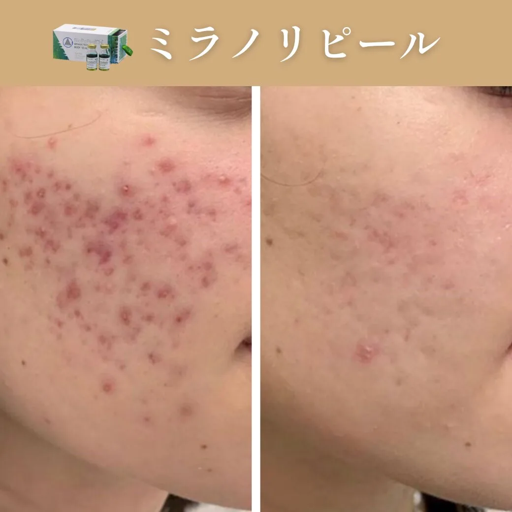 ミラノリピール（顔）